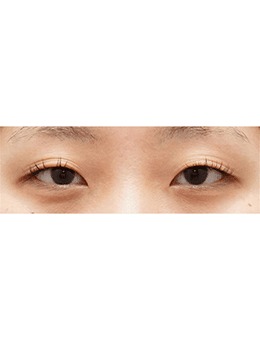 韩国得芘芘整形眼整形做超好，切开双眼皮手术图如下！