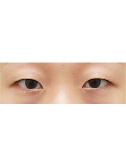 韩国THE BB整形做的双眼皮真美，术前术后3个月对比图公开！_术前