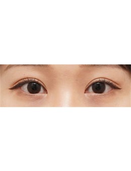 韩国THE BB整形做的双眼皮真美，术前术后3个月对比图公开！