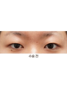 韩国THE BB整形做双眼皮怎么样，看完真人手术图就明白了！_术前