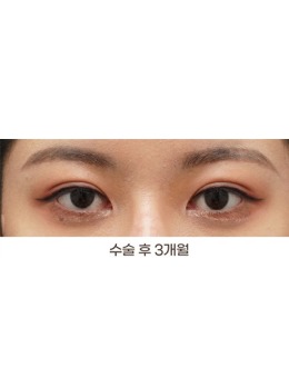 韩国THE BB整形做双眼皮怎么样，看完真人手术图就明白了！_术后