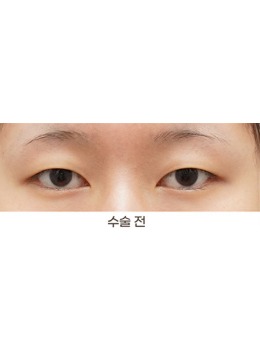-韩国THE BB整形做眼睛好吗，是韩国人认可的正规整形医院！