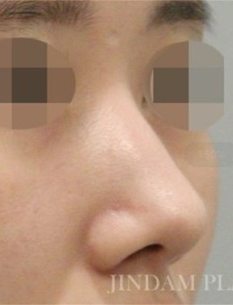 韩国真谈整形做鼻子好吗？附真人手术对比图变化惊艳！_术前