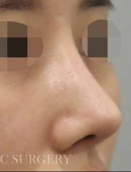 韩国真谈整形做鼻子好吗？附真人手术对比图变化惊艳！_术后