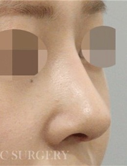 -做鼻子就来韩国真谈整形，鼻修复技术很牛！