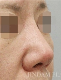 韩国真谈整形鼻修复术前术后对比照公开，变化惊人！_术前