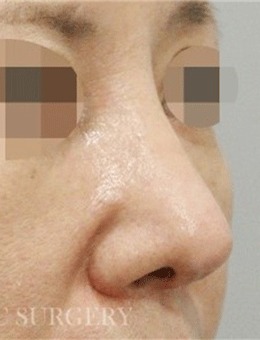 韩国真谈整形鼻修复术前术后对比照公开，变化惊人！