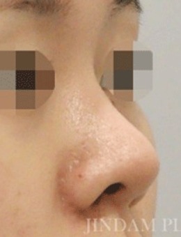 鼻子修复术还得看韩国真谈整形，后悔没早点做！