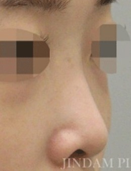 韩国做鼻子哪家好？真谈整形外科做鼻子真的很棒！