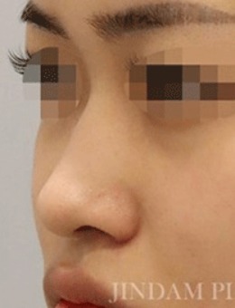拒绝容貌焦虑，来韩国真谈整形做鼻子矫正手术吧！