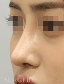 -拒绝容貌焦虑，来韩国真谈整形做鼻子矫正手术吧！