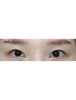 韩国双眼皮整形医院哪家好?Beulibal整形自然粘连法双眼皮做的好!