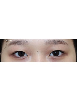 韩国整形外科哪家强？Beulibal整形双眼皮手术很出名！_术前