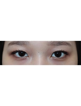 韩国整形外科哪家强？Beulibal整形双眼皮手术很出名！