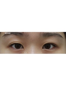 韩国双眼皮整形推荐Beulibal整形，术后自然真惊艳！