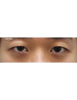 韩国眼部整形哪家好？Beulibal整形手术对比图真自然！_术前
