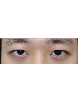 韩国眼部整形哪家好？Beulibal整形手术对比图真自然！_术后