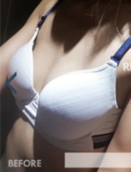 韩国丽珍整形外科假体隆胸对比图