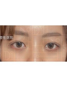 韩国DI整形-DI整形医院双眼皮术前术后对比图分享！