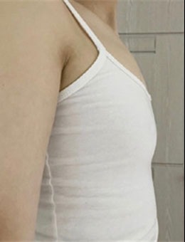 韩国傲婷美假体隆胸案例前后对比图