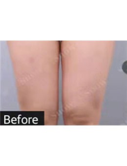 韩国SNOW医院大腿环吸360度+膝盖内侧吸脂，术后拥有纤纤细腿！_术前