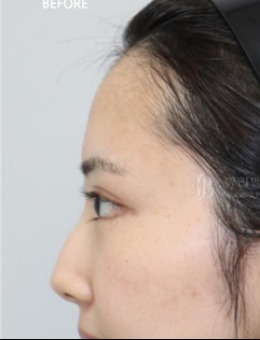 韩国Beulibal整形真人鼻部整形+额头脂肪移植案例分享！_术前