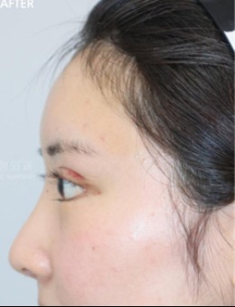 -韩国Beulibal整形真人鼻部整形+额头脂肪移植案例分享！