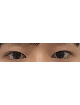 双眼皮变化真惊艳，我推荐韩国赫尔希整形医院！