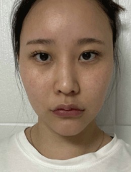 -韩国VIBE整形眼角修复术＋鼻整形＋面部吸脂日记分享！
