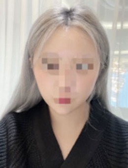 韩国赫尔希整形迷你轮廓提升术分享，术后脸型精致了许多！