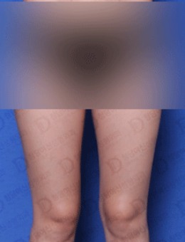 在韩国女神整形做完腿部吸脂修复后的效果_术前