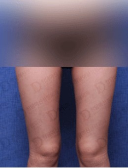 在韩国女神整形做完腿部吸脂修复后的效果_术后