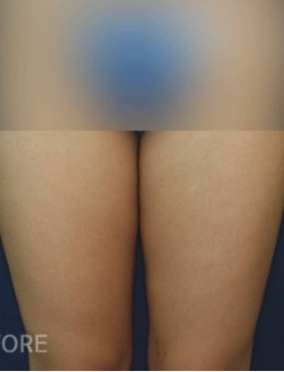 韩国贝缇莱茵腿部吸脂手术案例