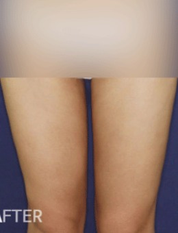 beautyline整形外科-韩国贝缇莱茵腿部吸脂手术案例