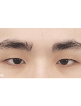 韩国喜可整形做眼睛怎么样？做男士眼睛做的好！