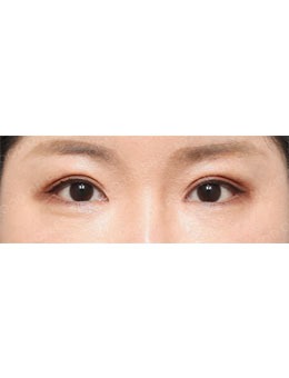 韩国moodon整形外科做眼睛怎么样，拿真人案例来说话！