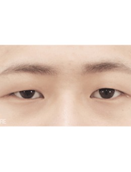 在韩国喜可整形做完双眼皮，整个人都帅了！_术前