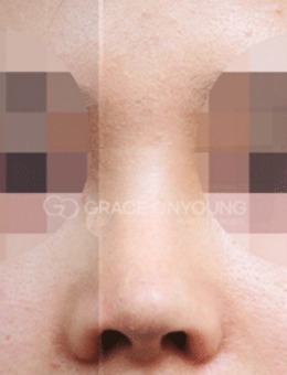 韩国做鼻子推荐的医院，格瑞丝噢爱美整形鼻修复很擅长！_术后