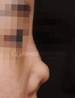 韩国格瑞丝噢爱美萎缩鼻能修复吗？可以修复而且非常不错！_术前