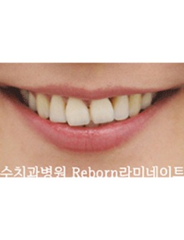 -在韩国SU牙科做了牙贴面，变化好大真的太给力了！