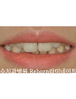 韩国牙齿修复哪家好？韩国SU牙科很擅长牙齿修复！