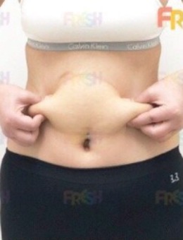 韩国芙莱思整形医院腰腹部吸脂手术对比案例