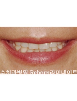 -快来韩国SU牙科做牙贴片修复吧，牙贴片前后对比图明显！