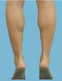 韩国江南三星整形外科小腿塑形手术图