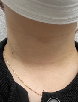 韩国Parkview整形去颈纹手术图