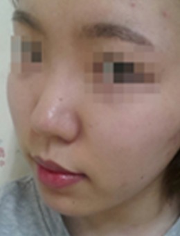 韩国WILL整形外科-韩国will医院鼻子手术图片