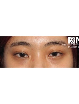 韩国延世ENB整形外科双眼皮宽改窄案例,术后真好看!_术前