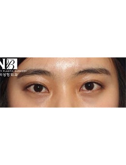 韩国延世ENB整形外科双眼皮宽改窄案例,术后真好看!_术后