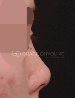 韩国格瑞丝噢爱美做鼻子超好看，做鼻子前后对比图分享！