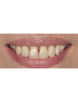 牙齿稀疏牙缝大怎么矫正？韩国SU牙科的牙齿贴面就能解决!